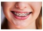 Trusted Orthodontist in Paldi for Braces & Smile Makeovers