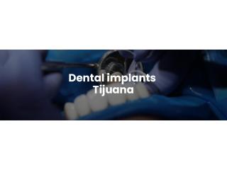 Dental implants Tijuana offers natural-looking and durable teeth replacements Dental implants Tijuana offers natural-looking and durable teeth replacements