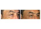 Skin Tags on Eyelids Removal – Gentle and Safe Care at London Dermatology Clinics