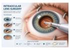 Intraocular Lens Surgery in Germany – Restore Clear Vision Today