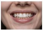 Cosmetic Dentistry in San Antonio, TX