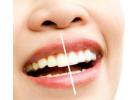 Professional Teeth Whitening PA Services Delivering Brighter Smiles With Comfortable Modern Dental C