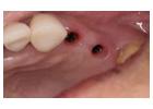 Find Trustworthy Teeth Replacements with Tijuana Dental Implants