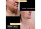 Best Breast Augmentation Campbell