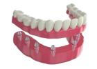 Comfortable Dentures in Bristol PA for a Natural Looking Confident and Healthy Smile